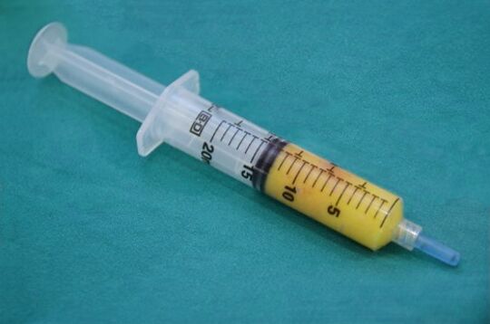 Syringe for lipofilling with adipose tissue