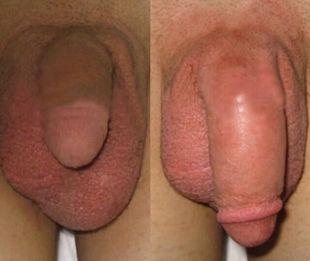 The result of placing a collagen matrix in the penis
