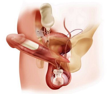 Surgical penis enlargement